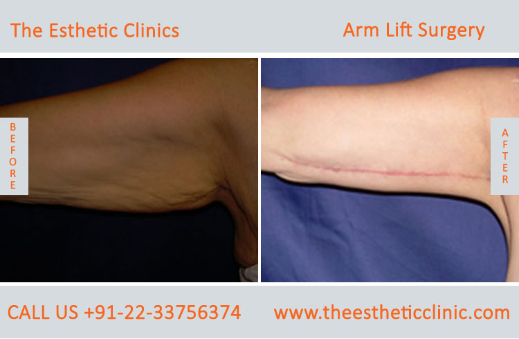 Arm Lift Surgery, Brachioplasty before after photos in mumbai india (3)